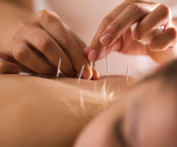 Acupuncture / Cupping